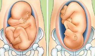 胎位不正怎么纠正 胎位不正怎么纠正